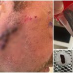 VIDEO Caz medical socant Un satmarean a fost operat dupa ce medicii au uitat bucati de lemn in fata