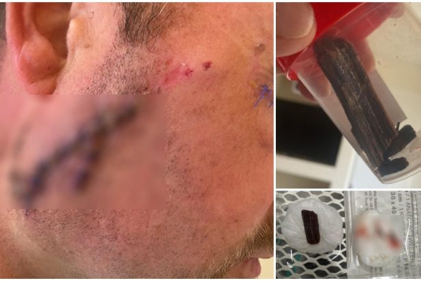 VIDEO Caz medical socant Un satmarean a fost operat dupa ce medicii au uitat bucati de lemn in fata
